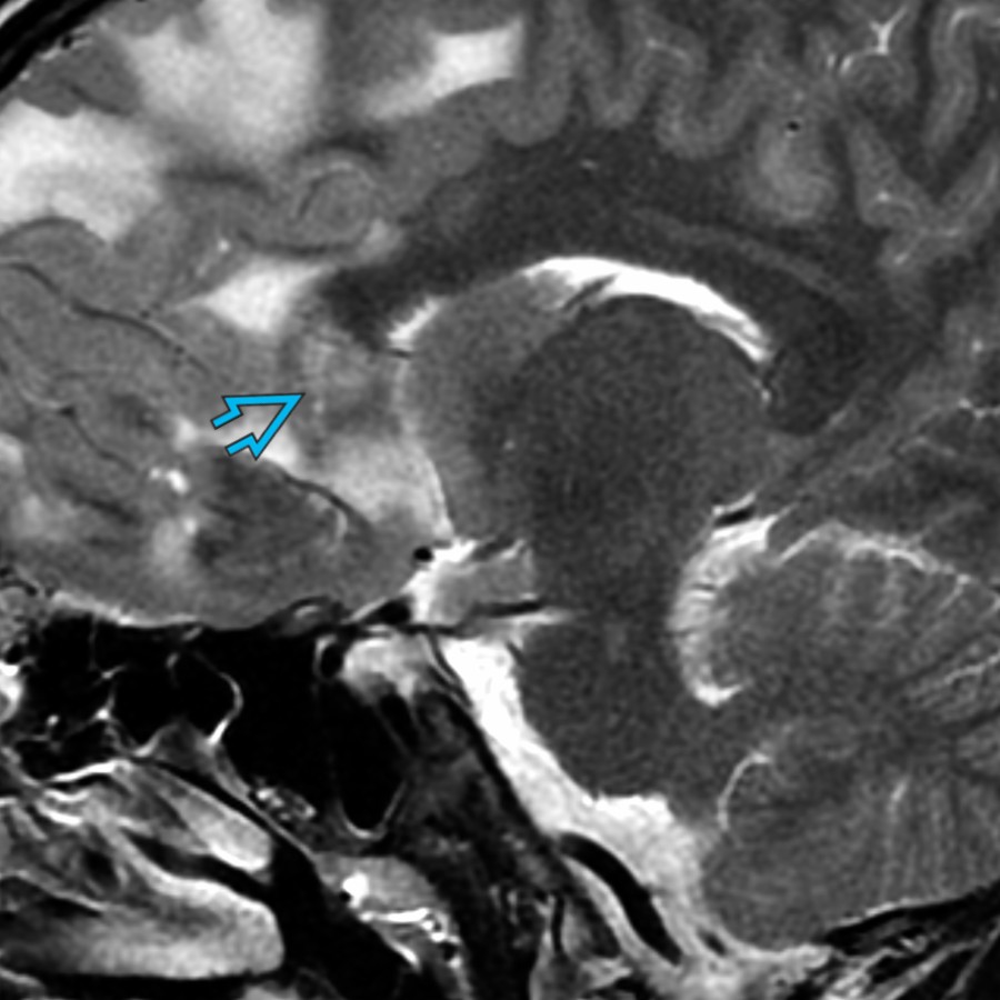 Midline sagittal T2 MR shows expansion & increased signal in the rostrum & anterior genu of the CC , consistent with tumor infiltration/edema in this patient with CNS lymphoma.