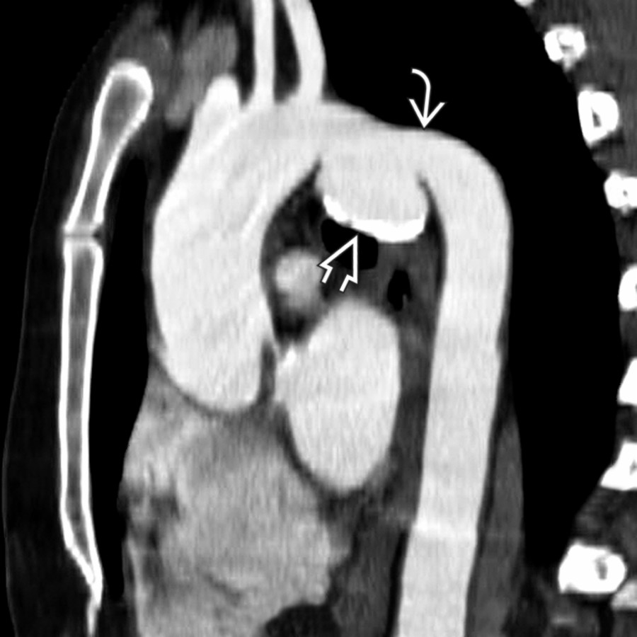 Oblique sagittal chest CTA in an asymptomatic patient with CTAI and right diaphragmatic hernia shows a well-defined aortic pseudoaneurysm  at the aortic isthmus. Note characteristic sudden change in caliber  of the aorta distally, a common finding.