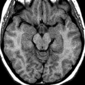 Axial T1WI MR shows no apparent abnormal signal intensity in the substantia nigra in a patient with PKAN.