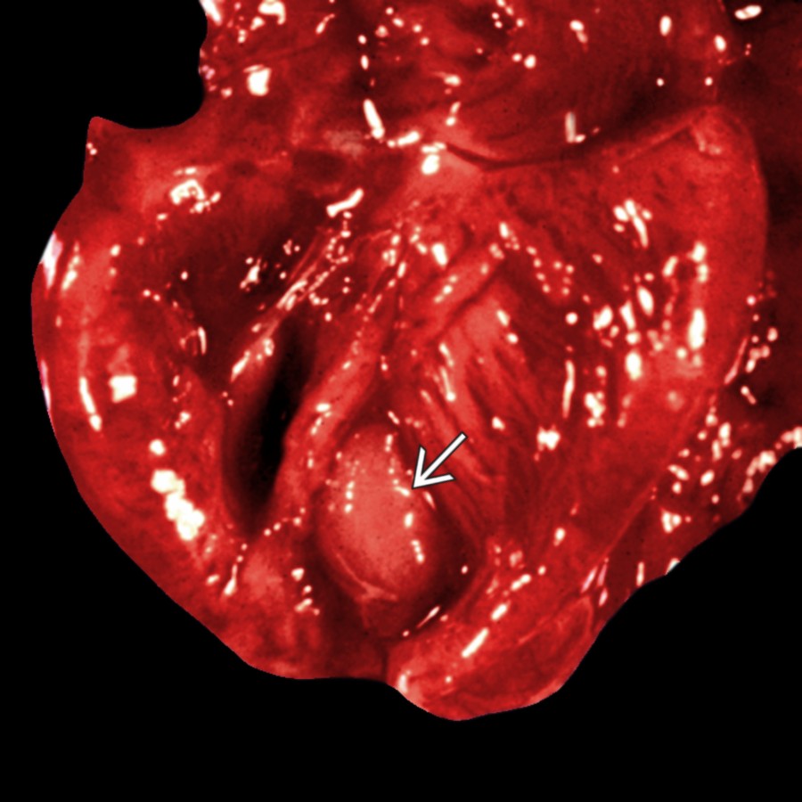Gross pathology of the heart shows a well-defined mass  arising from the wall of the ventricle. Histology confirmed a rhabdomyoma.