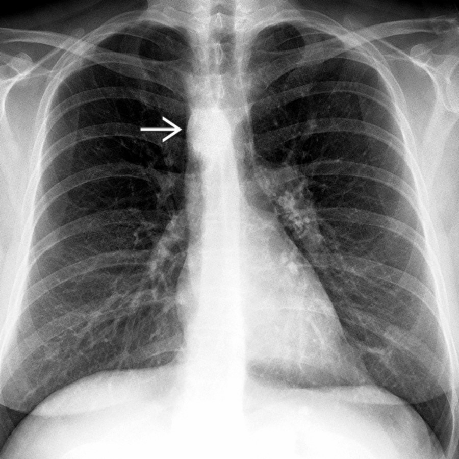 PA chest radiograph in a patient with right aortic arch (RAA) and aberrant left subclavian artery (ALSA) without Kommerell diverticulum (KD) shows RAA  as a right paratracheal nodular opacity with right tracheal indentation.