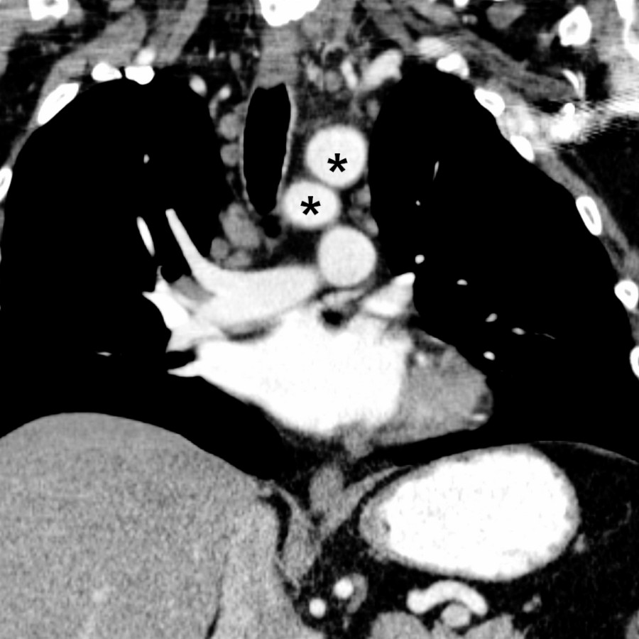 Coronal CTA in the same patient shows the short axis of aortic arches with a double-barrel appearance (*). The 4th and persistent 5th arch have a figure of 8 configuration in the short axis, which allows differentiation from dissection.