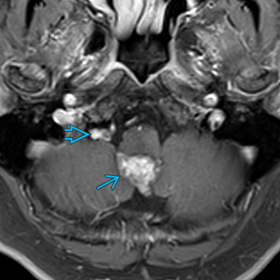 Axial T1 C+ MR shows an enhancing mass in the 4th ventricular outflow tract . The moderate enhancement is uncommon. Subependymomas classically have no or minimal enhancement. They can protrude through the foramen of Magendie. In this case, tumor is also present anterior to the cerebellar hemisphere  through the foramen of Luschka.