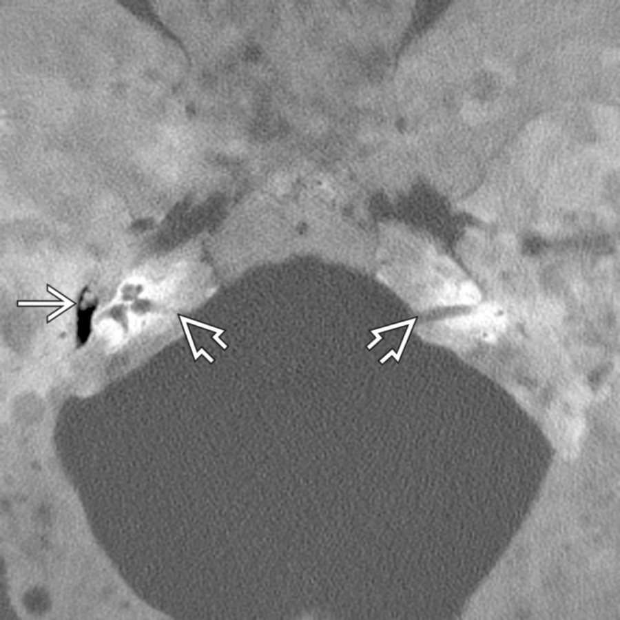 Axial bone CT in a teenage boy with polyostotic fibrous dysplasia and precocious puberty (McCune-Albright syndrome) shows severe involvement of the skull base with ground-glass opacification. The middle ear spaces , IACs , and other foramina are small. Note relative otic capsule sparing.