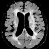Axial FLAIR MR in an 80-year-old man with VaD demonstrates extensive confluent hyperintense signal in bilateral cerebral hemispheric WM   due to chronic ischemic changes and a remote lacunar infarct in right coronal radiata . Note the prominent cortical sulci  due to diffuse parenchymal volume loss.
