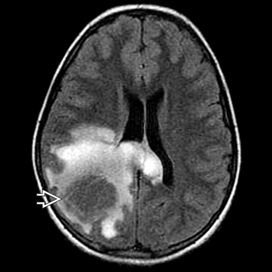 Axial FLAIR MR  in a teen patient with acute left body weakness and sensory disturbance  shows a tumefactive lesion  with surrounding T2 hyperintensity extending into the corpus callosum. Differential considerations include neoplasm and abscess in addition to demyelinating disease.