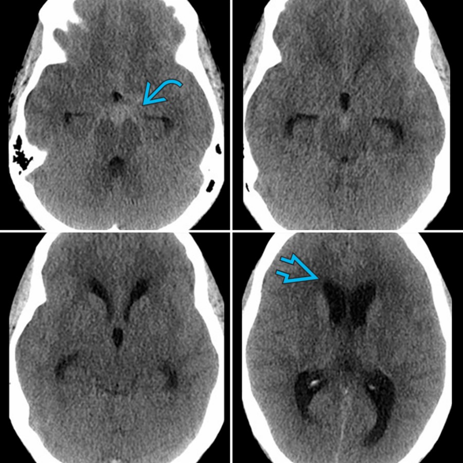 Axial NECT shows acute subarachnoid hemorrhage  in the basal cisterns and early extraventricular obstructive hydrocephalus with dilatation of all the ventricles and subtle periventricular hypodensity  due to interstitial edema.
