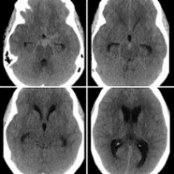 Axial NECT shows acute subarachnoid hemorrhage  in the basal cisterns and early extraventricular obstructive hydrocephalus with dilatation of all the ventricles and subtle periventricular hypodensity  due to interstitial edema.