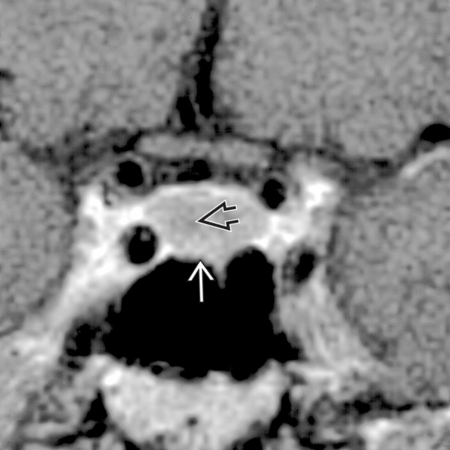 Coronal T1 C+ MR in a 51-year-old man shows a mildly enlarged pituitary gland  measuring 11 mm in height. Note the faint area of slightly less enhancement . An 8-mm microadenoma was found at surgery.
