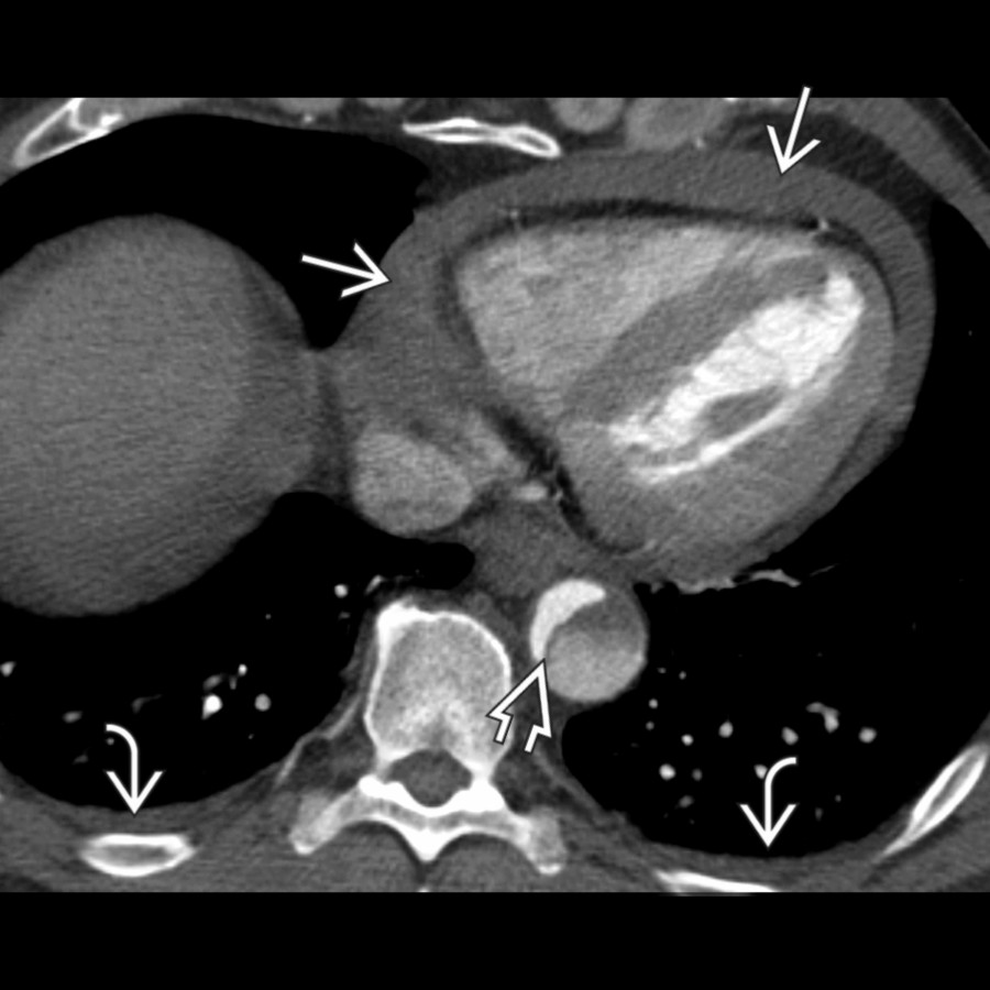 Axial CECT shows a high-attenuation pericardial effusion , consistent with a hemopericardium, as well as bilateral trace pleural effusions . The dissection flap is clearly visible in the descending thoracic aorta .