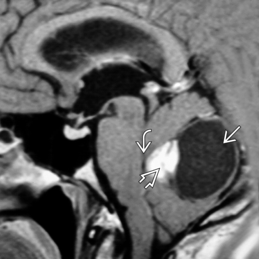 Sagittal T1WI C+ MR shows a cyst  with an enhancing mural nodule  of hemangioblastoma in the vermis, causing severe effacement of the 4th ventricle  and obstructive hydrocephalus.