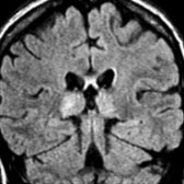 Coronal FLAIR MR in the same patient with CJD demonstrates hyperintense signal in both thalami.