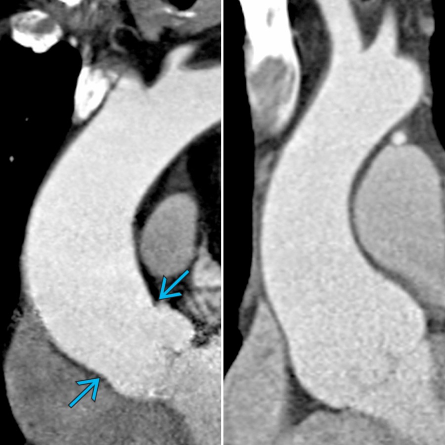 Coronal oblique CECT shows aneurysms associated with bicuspid aortic valve (left) and Marfan syndrome (MFS) (right) to exemplify annuloaortic ectasia. Note that a sinotubular junction is still identifiable in dilatation due to bicuspid aortic valve  but is effaced in MFS due to dilated aortic root.