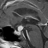 Sagittal T1 C+ FS MR shows marked enlargement of the pituitary infundibulum  related to infundibuloneurohypophysitis.