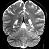 Coronal T2WI MR in an 18-year-old woman with Woodhouse-Sakati syndrome (WSS) shows mild confluent hyperintensities in the cerebral periventricular   & cerebellar peridentate white matter .