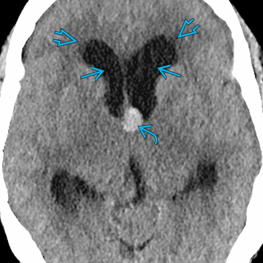 Axial NECT in a patient with headache demonstrates a classic colloid cyst at the foramen of Monro  causing IVOH with dilatation of both lateral ventricles . Note the periventricular hypodensities  due to transependymal leakage of CSF.