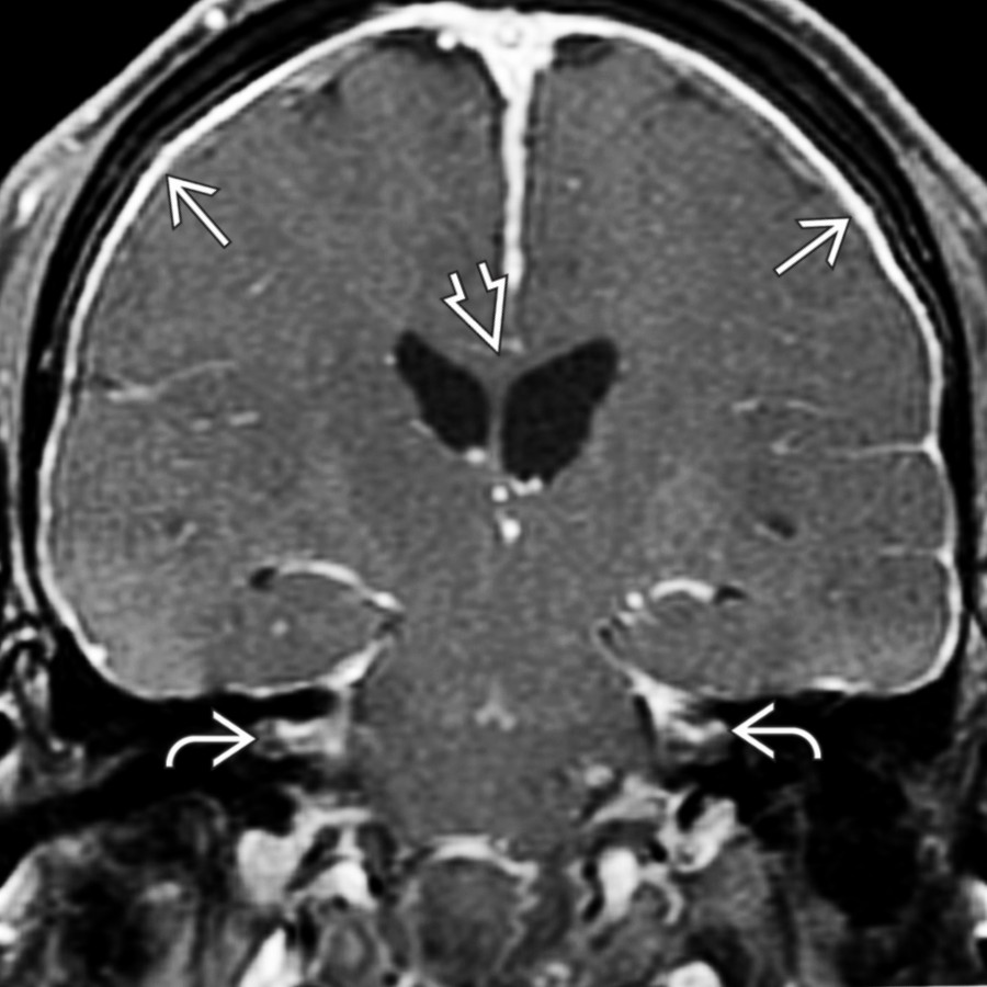 Coronal T1 C+ FS MR in the same patient shows the diffuse dura-arachnoid enhancement  extends into both internal auditory canals . The lateral ventricles have a more acute angle  and appear "pulled down" toward the incisura. An epidural blood patch relieved the symptoms.