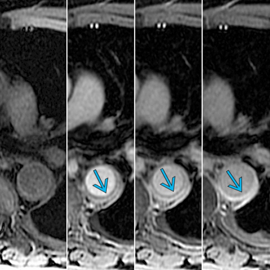 3D GRE MR (unenhanced and post contrast) at the same level shows progressive enhancement of the aortic wall after administration of intravenous contrast .