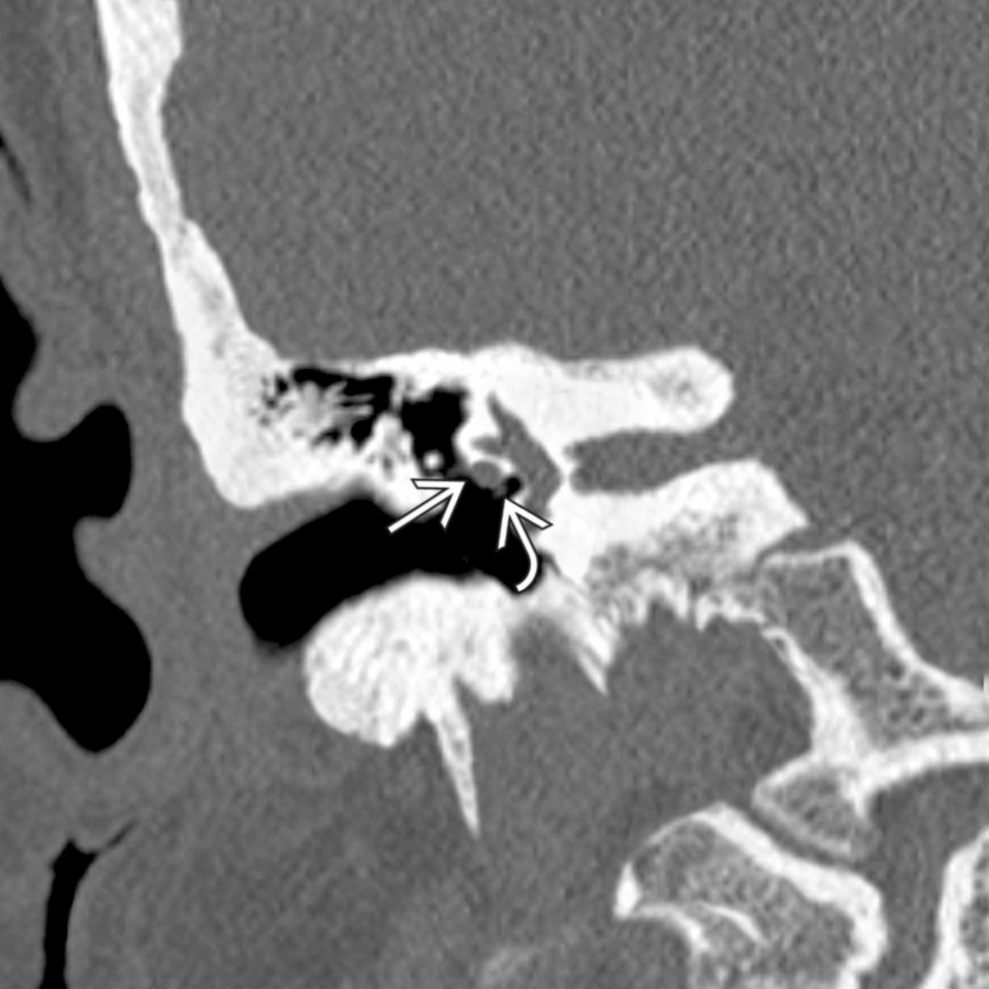 Coronal bone CT of the right ear in a patient with sensorineural hearing loss (SNHL) shows incidental prolapse of the tympanic portion of the facial nerve . The nerve is slightly larger than normal and devoid of a  bony canal. A tiny density just below the facial nerve is a portion of the stapes crus .