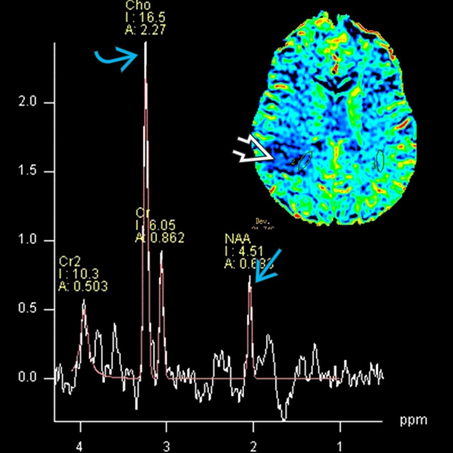 MRS at 144 TE in the same patient demonstrates a large choline peak  with ↓ in NAA . MRS in a tumefactive demyelinating lesion is not specific and can mimic a tumor profile. MR DSC perfusion (insert) shows marked ↓ rCBV , which goes more in favor of a demyelinating lesion.
