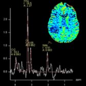 MRS at 144 TE in the same patient demonstrates a large choline peak  with ↓ in NAA . MRS in a tumefactive demyelinating lesion is not specific and can mimic a tumor profile. MR DSC perfusion (insert) shows marked ↓ rCBV , which goes more in favor of a demyelinating lesion.