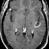 Axial T1 C+ MR shows an incomplete ring of peripheral enhancement, typical of a demyelinating process. Other contrast enhancement patterns include ovoid or punctate homogeneous enhancement.