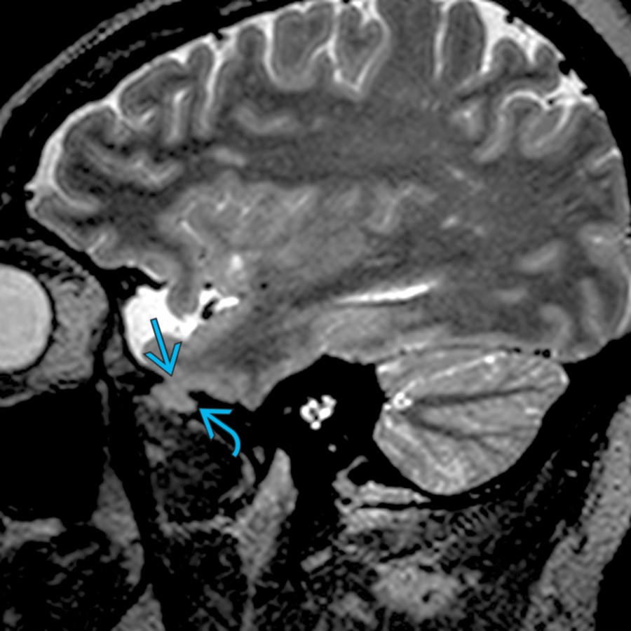 Sagittal T2 MR in a young female with IIH and temporal lobe epilepsy shows a defect   along the floor of the middle cranial fossa with herniation of the anteroinferior temporal lobe .