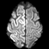 Axial DWI MR through the vertex in the same patient shows involvement of perirolandic cortex on right . Typically the perirolandic cortex, cerebellum, and white matter are relatively spared in CJD.