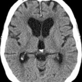 Axial NECT in a 83-year-old man demonstrates mild sulcal enlargement  & mild ventriculomegaly . The white matter appears relatively normal with subtle periventricular hypodensities.