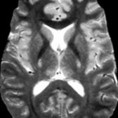 Axial T2WI MR in a young man with ALS shows symmetric hyperintense CSTs  at the level of the internal capsule.