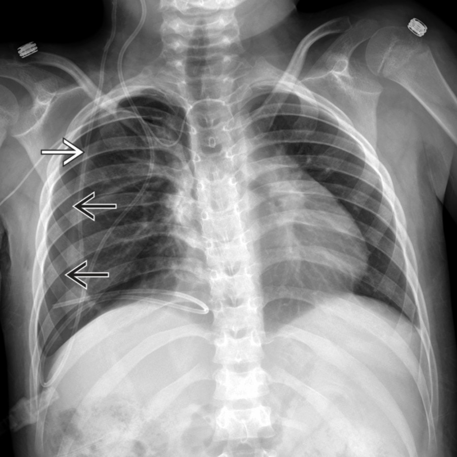 AP radiograph in a patient with chest pain after ventriculopleural (VPL) shunt placement depicts a right pneumothorax  related to the shunt placement. Note the abandoned catheter fragment  from a prior VP shunt system.