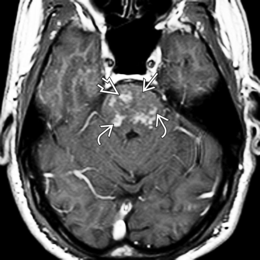 Axial T1 C+ MR shows scattered, faint, punctate enhancing foci  as well as larger confluent, nodular , and partial ring-enhancing  lesions in the pons.