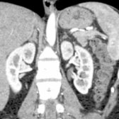 Coronal view demonstrates the relationship between the adrenals and adjacent organs.