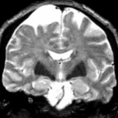Coronal T2WI MR in an elderly patient shows marked hypointensity in both lenticular nuclei & wide cortical sulci.