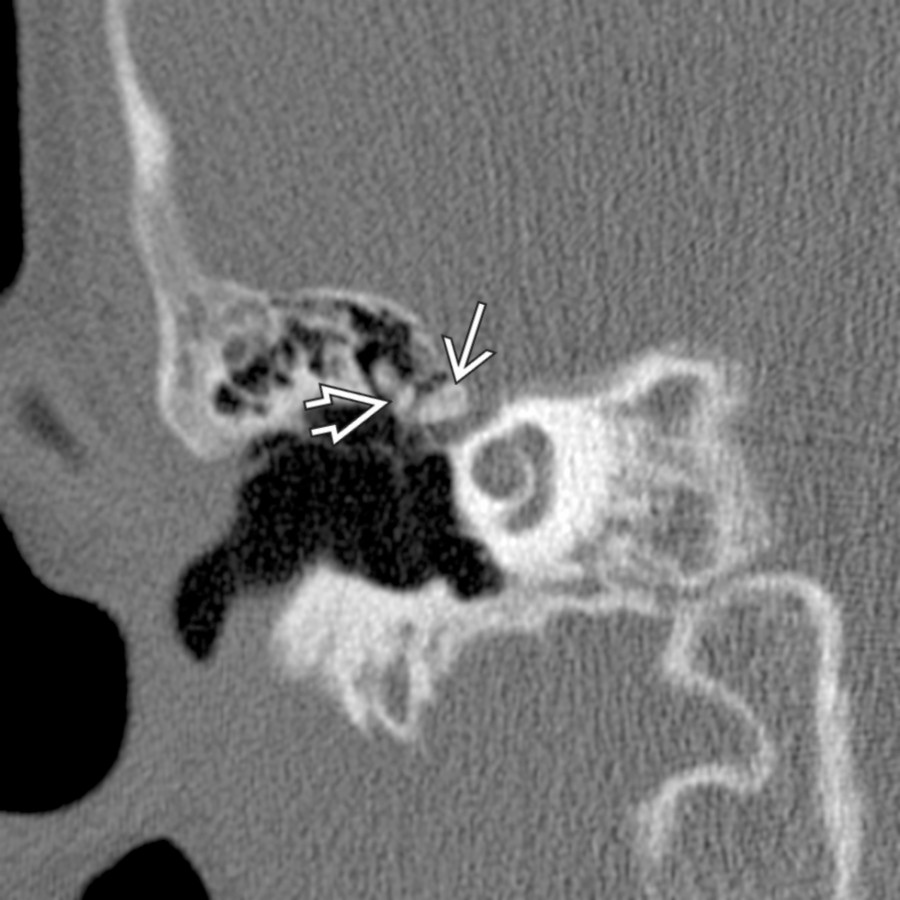 Sagittal bone CT demonstrates disrupted ossicles in the attic  and healing bone in the lateral roof of the geniculate fossa . Six weeks after temporal bone fracture, persistent conductive hearing loss and facial nerve paralysis were still present.