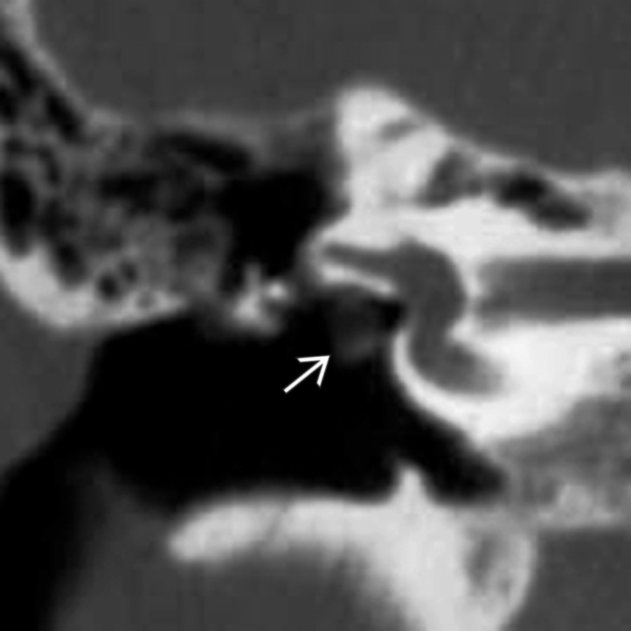 Coronal temporal bone CT of the right ear shows a soft tissue mass in the oval window niche  along the undersurface of the lateral semicircular canal in the location of a  normal tympanic facial nerve segment. A prolapsing facial nerve was diagnosed at surgery.