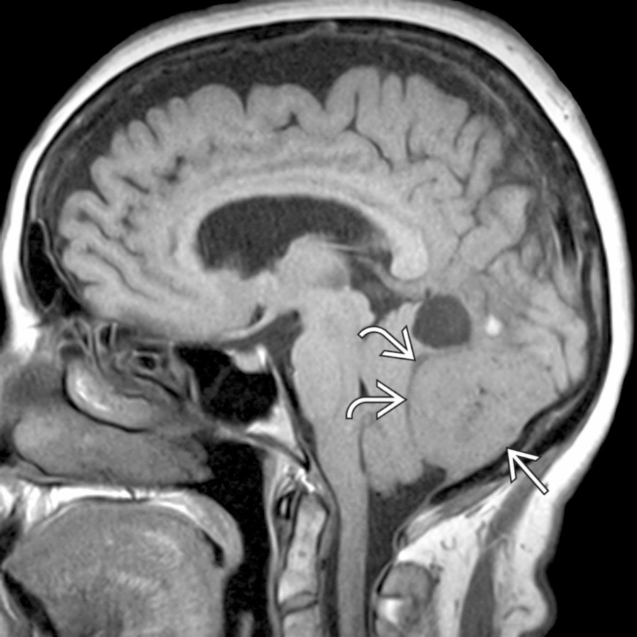 Sagittal T1WI MR demonstrates dural-based tumor  with significant mass effect compressing and displacing the cerebellum. Note the trapped CSF clefts . The tumor encroaches on the cisterna magna.