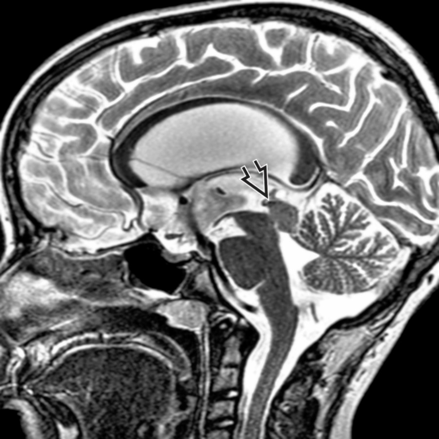Midline sagittal T2 MR shows mild stretching & thinning of the corpus callosum due to hydrocephalus. There is obstruction of the aqueduct of Sylvius by a tectal glioma .