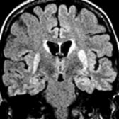 Coronal FLAIR MR shows hyperintense signal in caudate nuclei, lentiform nuclei, and within temporal lobe cortices and hippocampi.