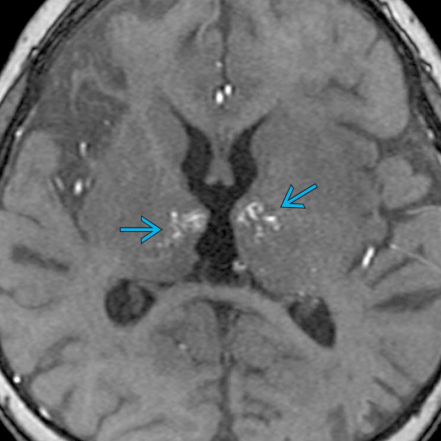 Axial time-of-flight MRA in a 2-year-old with multiple infarcts of various ages shows multiple small areas of flow-related signal  in the bilateral thalami, consistent with lenticulostriate collaterals of moyamoya.