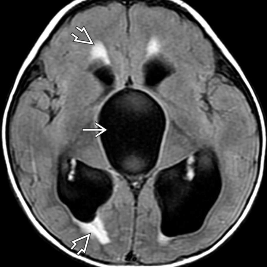 Axial FLAIR MR shows massive enlargement of the 3rd and lateral ventricles by a CSF-like mass within the 3rd ventricle . There is periventricular interstitial edema . At surgery, an ependymal cyst of the 3rd ventricle was found and fenestrated.