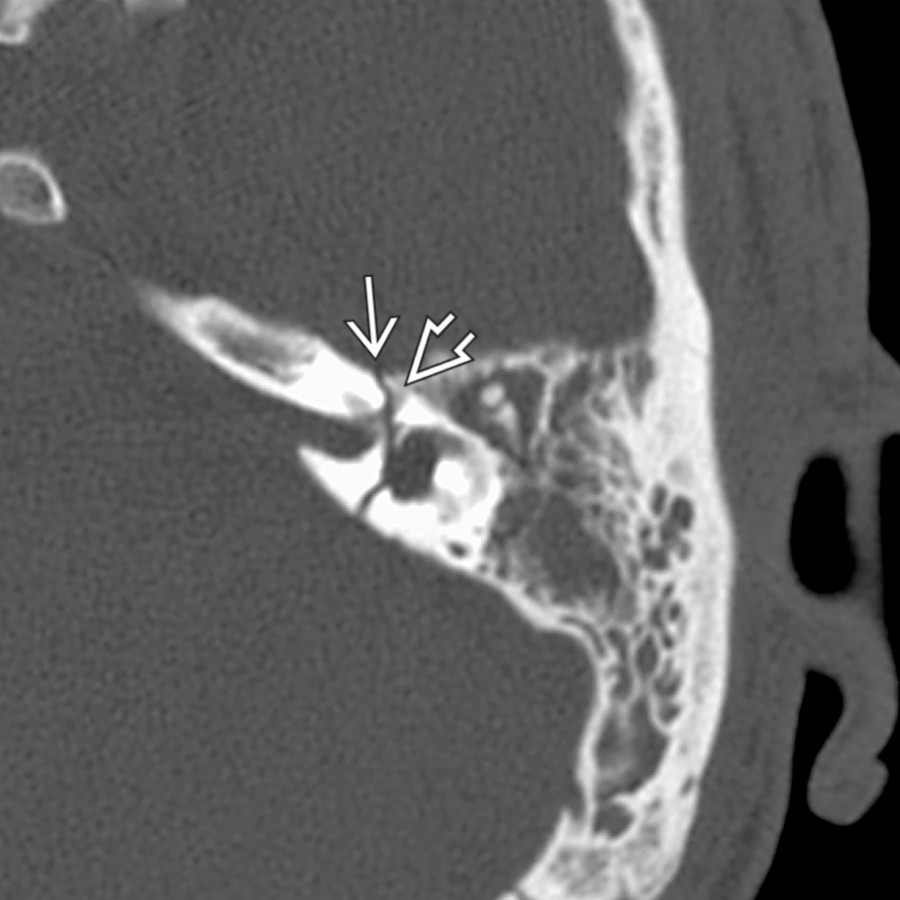 Axial bone CT demonstrates a transverse fracture through the inner ear. The fracture line  passes anteriorly through the labyrinthine segment of the facial nerve canal .