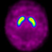 I-123 ioflupane scan demonstrates normal symmetric activity in the head of the caudate  and putamen bilaterally , effectively ruling out LBD.