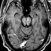 More cephalad T1 C+ FS MR in the same patient shows additional lesions in the midbrain  and medial temporal lobe .