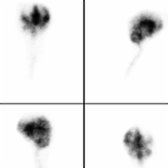 24-hour multiplanar images in the same patient show tracer in lateral ventricle , confirmed by vertex and SPECT images (not shown).