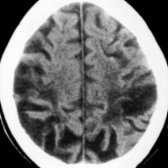 Axial NECT shows WM hypodensity as well as bilateral frontal and parietal evolving cortical remote infarctions . Note the associated focal biparietal cortical atrophy .