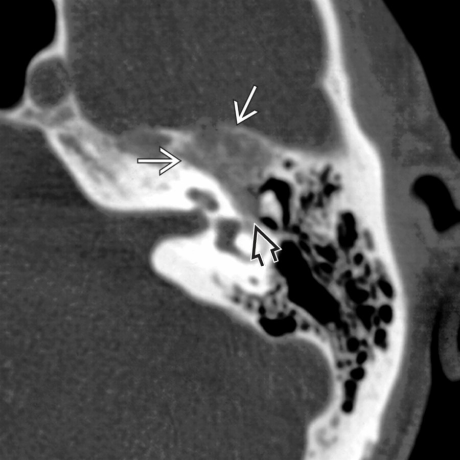 Axial bone CT demonstrates the honeycombing appearance of FNVM centered in the geniculate fossa . Note extension of the lesion along the proximal tympanic CNVII segment .