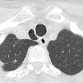 Axial NECT of a 59-year-old woman with tracheal diverticulum demonstrates a right paratracheal air collection . Note the diminutive and subtle connection with the trachea .
