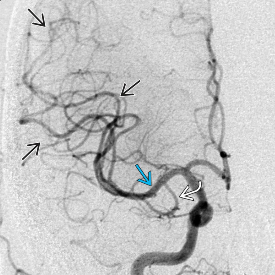 Right internal carotid DSA following mechanical thrombectomy shows a patent MCA  and distal branches , which were previously nonperfused. The anterior temporal branch  remains patent and is again seen arising from the mid-M1 segment.