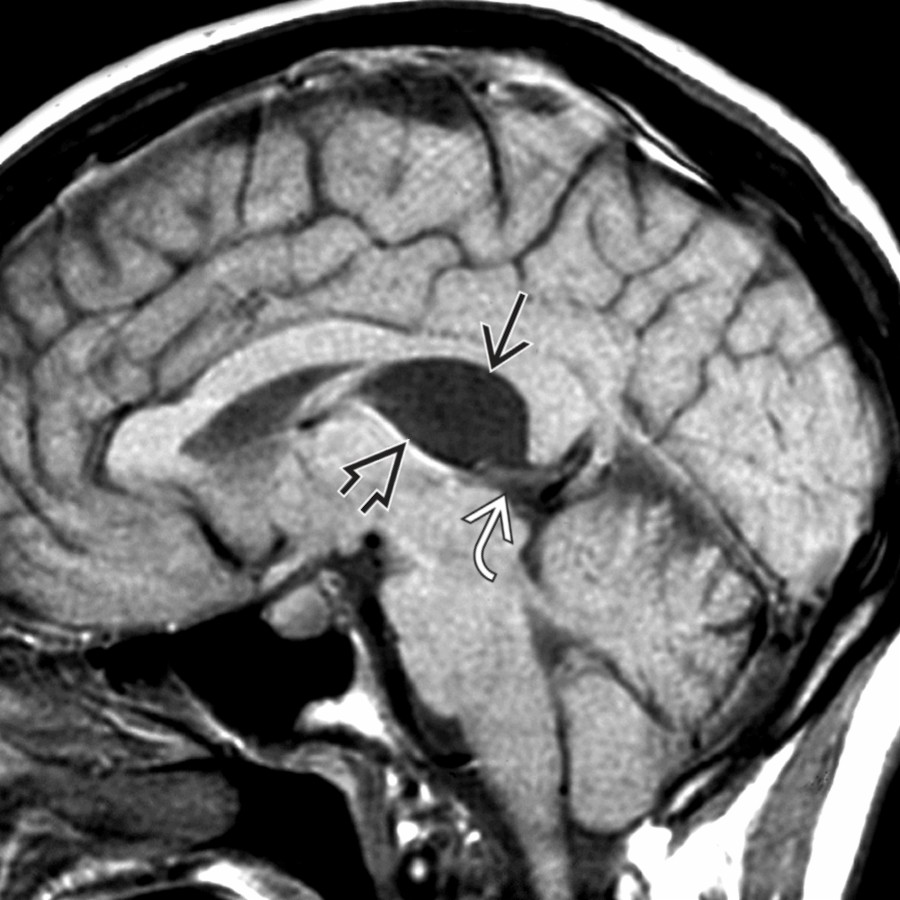Sagittal T1WI MR reveals a well-defined cavum velum interpositum , isointense with CSF, displacing the internal cerebral veins inferiorly  and compressing the quadrigeminal cistern .